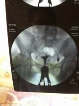 焦作市妇幼保健院试管婴儿谁做的好？怎样选择适合自己的医生？